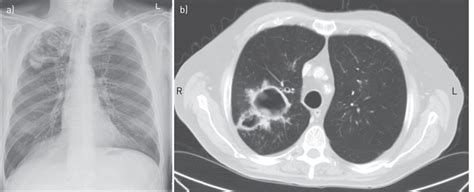 Chronic Pulmonary Aspergillosis Rationale And Clinical Guidelines For