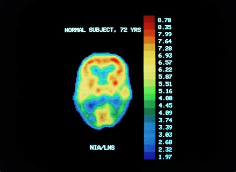 Pet Scan Of Brain Of Normal Subject Photograph By National Institute Of