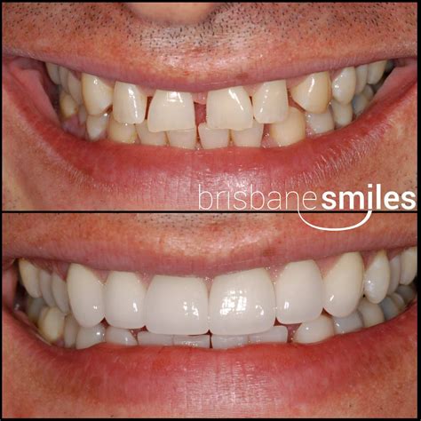 Porcelain Veneers Brisbane Smiles