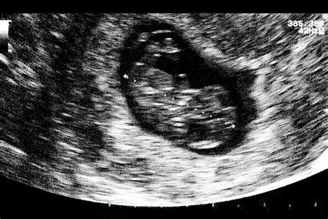 7th Week Of Pregnancy Ultrasound Pictures Pregnancywalls