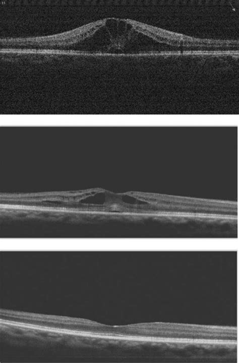 Spectral Domain OCT Macular Images Showing The Evolution Of Cystoid Download Scientific Diagram
