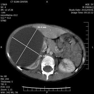 Contrast Enhanced Abdominal CT Scan Showed A Huge Simple Cyst Occupied