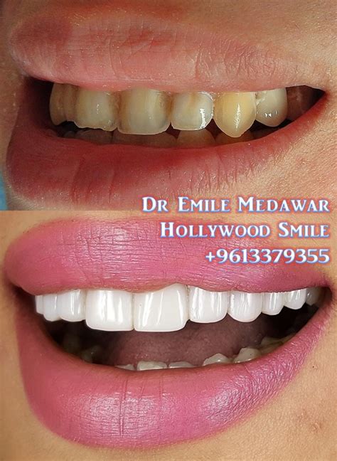 Separate but related functions that work together within the company protocols and budget. Direct Veneers