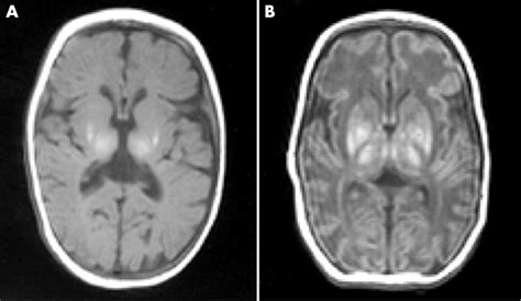 The Magnetic Resonance Revolution In Brain Imaging Impact On Neonatal