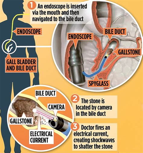 Spyglass Technique Blasts Painful Gallstones With Powerful Shockwaves