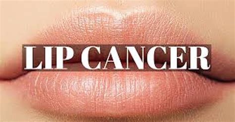 Lip Cancer Treatment Guidelines