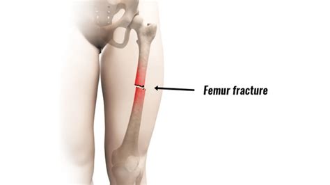 Fracture In Femur Types Causes Symptoms And Treatments Credihealth