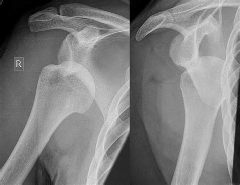 You would be required to pay two different bills that are the radiologist office and the housing faculty. Case study - shoulder injury treatment