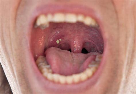 What Do Tonsil Stones Look Like In The Throat The 5 Variations