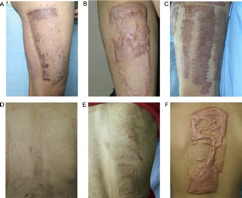 Figure 6 From Wound Healing Improvement By Resurfacing Split Thickness