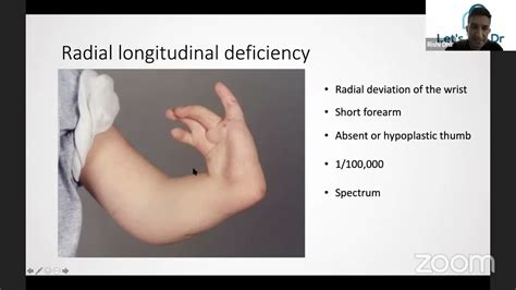 Congenital Deformities Of The Upper Limb Youtube