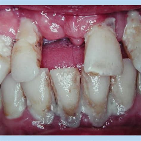 Pdf Periodontitis And Systemic Disease