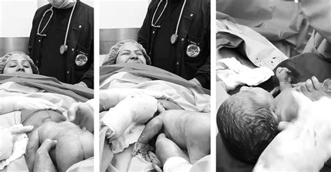 Must Watch Amazing C Section Breech Birth Video Captures Bottom First