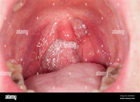 Tonsillitis Swollen Left Tonsil On Right Of A 24 Year Old Male