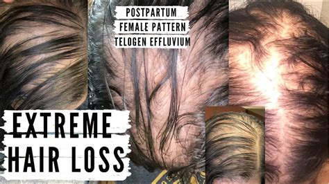 Extreme Hair Loss Postpartum Hair Loss Telogen Effluvium Female