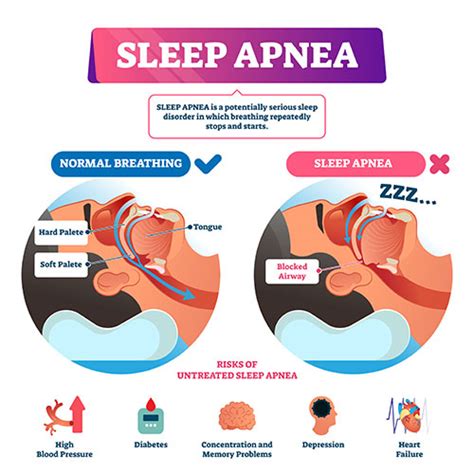 sleep apnea archives dr dalesandro and associates