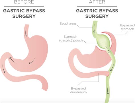 Procedure Gastric Bypass Operation