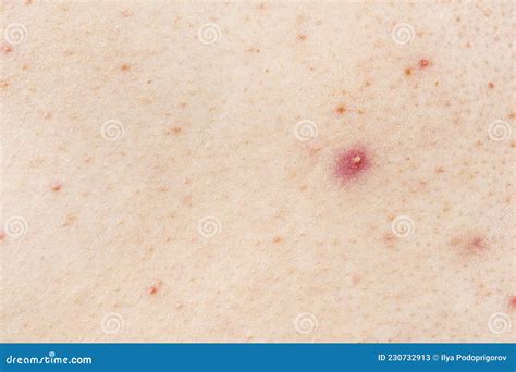 Skin Background Texture With Pimples And Blackheads Problematic Skin