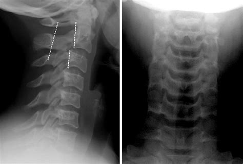 Assessment Of The Nearly Normal Cervical Spine Radiograph C2 C3