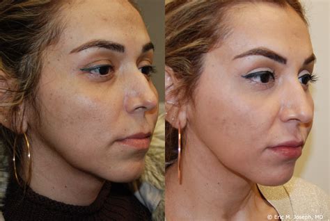 Eric M Joseph Md Silikon 1000 Before And After Non Surgical Rhinoplasty