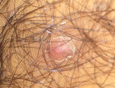 The small blisters eventually crust over and scab. Have I got herpes or is it something else? | Genital ...