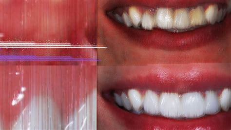 Woodland Hills Dentist Teeth Whitening Veneers Invisalign Youtube