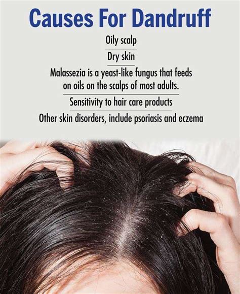 Dandruff Symptoms Causes And Treatment The Fit Body
