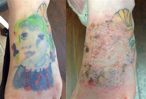 Tattoo Skin Reactions Allergies And Infections