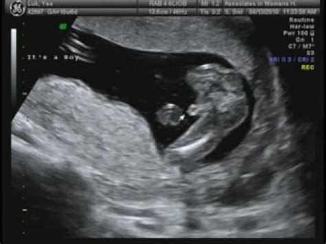 How to know if you re having a boy? 16 weeks Ultrasound - It's a Boy!!! - YouTube