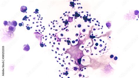 Fototapeta Cerebrospinal Fluid Csf Cytology From An Immunocompromised