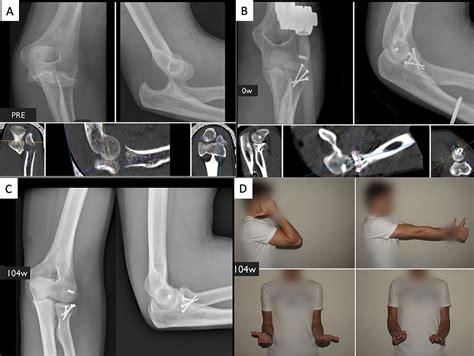 Functional Outcomes And Complications Of Radial Head Fractures Treated
