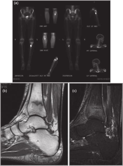 A Bone Scan Demonstrates Increased Tracer Uptake In The Proximal