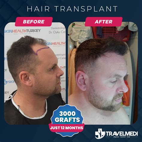 Fue Hair Transplant Travelmedi