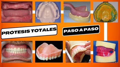 PrÓtesis Totales Prótesis Total Dental Paso A Paso Youtube