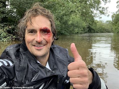 Tory Mp Johnny Mercer Gives Thumbs Up As Reveals Huge Black Eye From