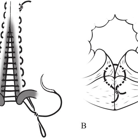 The Third Degree Perineal Laceration And Rectovestibular Fistulae In