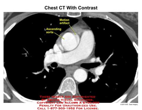 Amicus Illustration Of Amicusradiologyctchestcontrastmotion