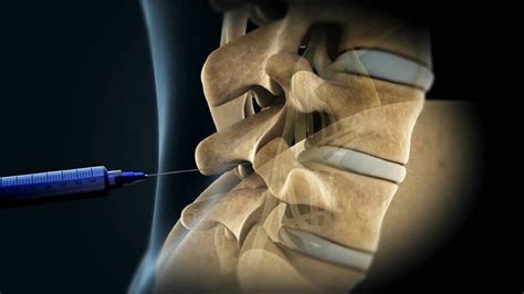 Lumbar Epidural Spinal Injection
