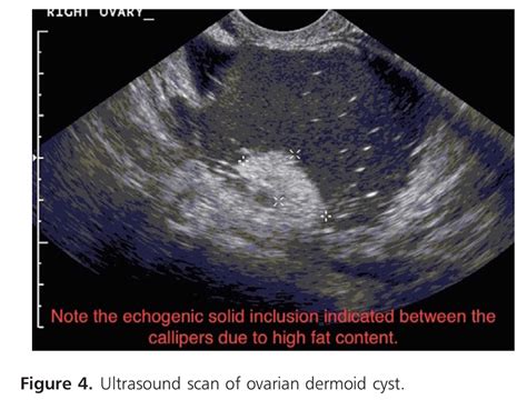 They also may become large and cause pain. TOG article : Management of adnexal masses in pregnancy ...
