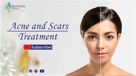 Acne And Scars Treatment Best Acne And Scars Treatment In Noida