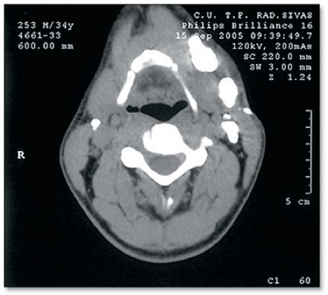 Several Calcified Lymph Nodes Are Seen In The Ct Image Download