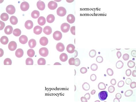 Erythropoiesis Rbc Production Hemoglobin Heme Globin Heme A