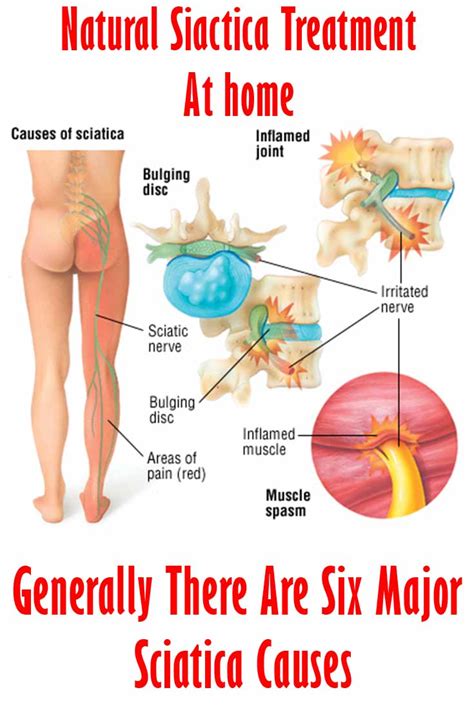 When sitting, try to square up so there is equal pressure on both sides of your body. Proven Exercises and Treatment to help remedy sciatica in ...