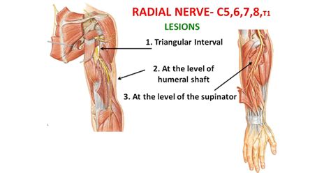 Lesions Of Radial Nerves