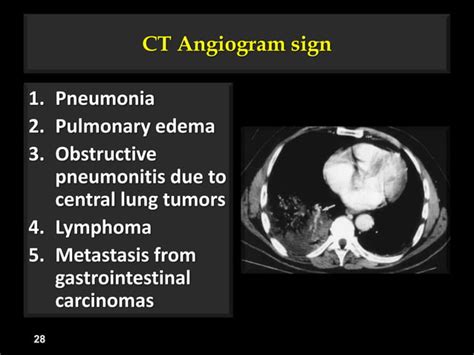 Deep Sulcus Sign Fallen Lung Sign Ct Angiogram Sign Flat Waist Sign
