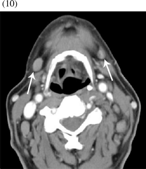 9 Level Ia Submental Nodes Ct Scan At The Level Of Open I