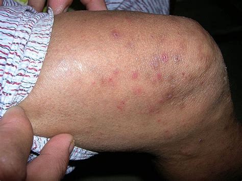 Dermatitis Herpetiformis Symptom Of Celiac Dermatitis Herpetiformis