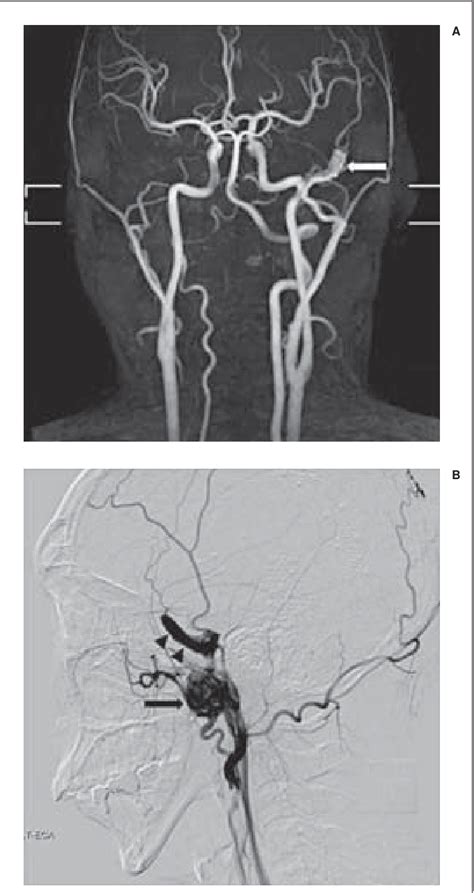 Figure From Traumatic Pseudoaneurysm Of The Middle Meningeal Artery