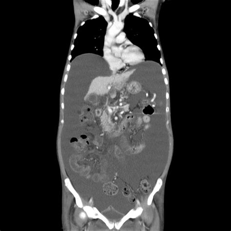 Ascites Ct Wikidoc