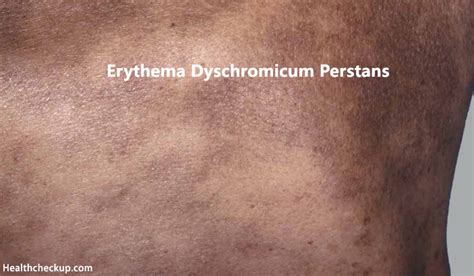 Erythema Dyschromicum Perstansashy Dermatosis Causes And Treatment